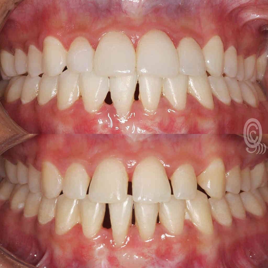 Diastema em resina